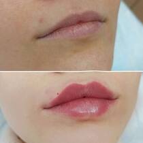 Увеличение губ препаратом Neauvia Intense Lips